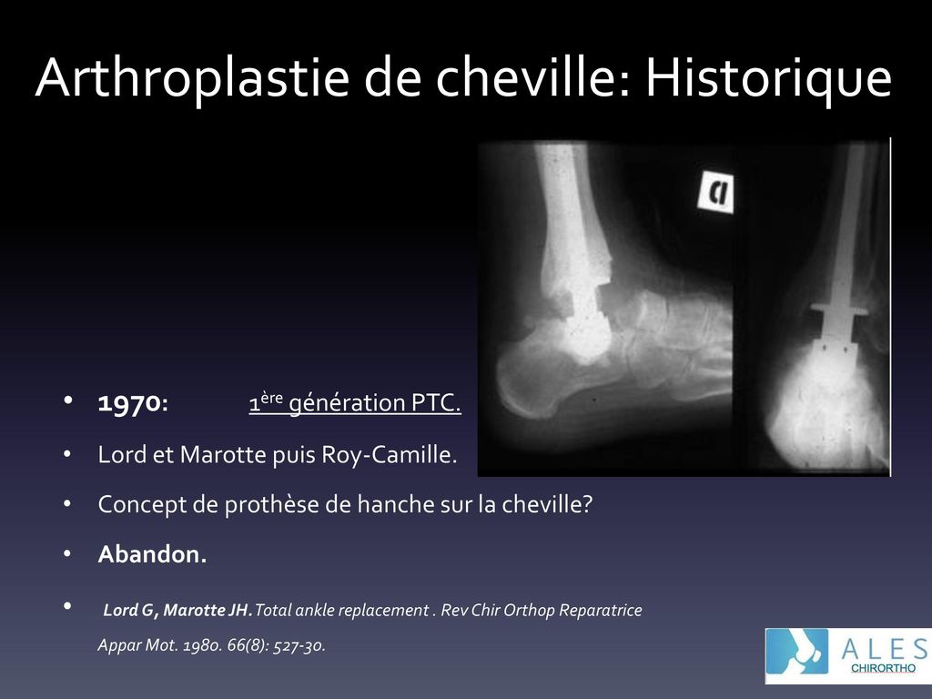 La Cheville d g n rative arthroplastie de cheville. 2e partie